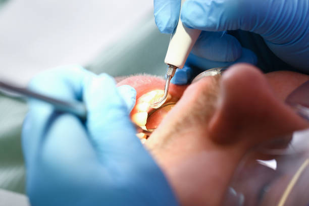 Best Emergency Dentist for Knocked-Out Tooth in Samoset, FL